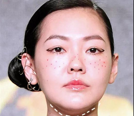 迷人计丨下颚骨太窄也会“胖”出双下巴?小S十元是这样让骨骼归正的