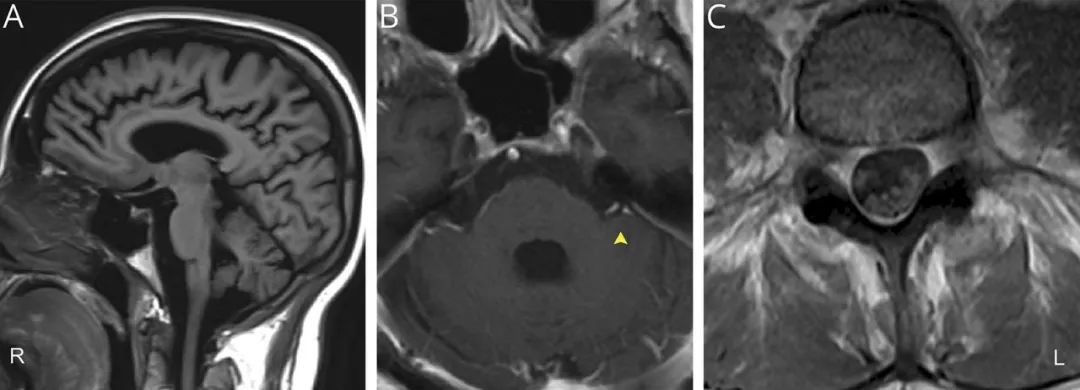这个慢性进行性疾病患者,为何出现急性、亚急性症状?丨临床推理