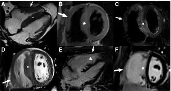 扩张型心肌病用什么消融,梗阻性肥厚性心肌病开胸手术恢复