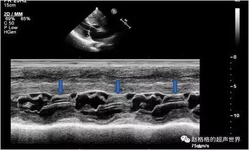 扩张型心肌病用什么消融,梗阻性肥厚性心肌病开胸手术恢复