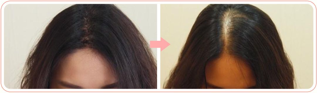 我不想秃头怎么办,防脱生发的正确方式