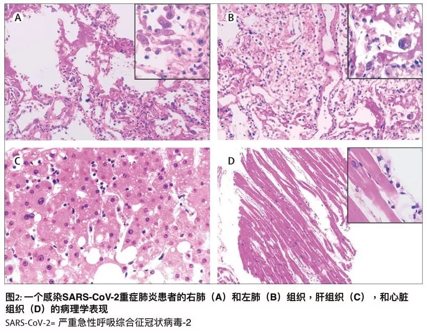 全国首例新冠肺炎解剖,世界首例新冠肺炎解剖第一人