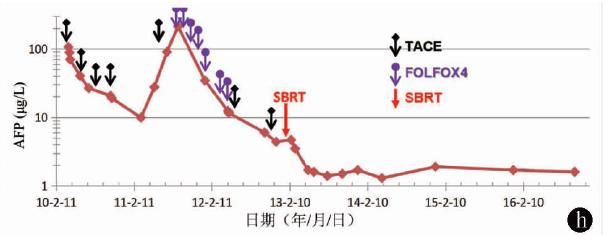 专家访谈肝癌,曾昭冲给谁治疗过