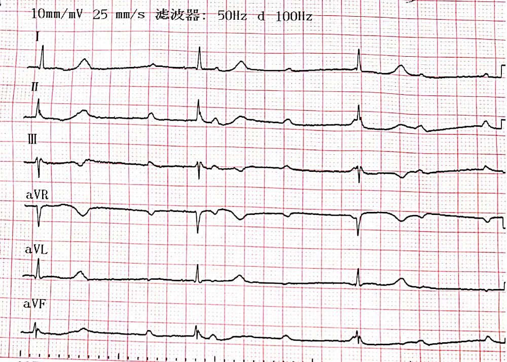 pd1单抗皮质醇,pd-1单抗治疗的前提