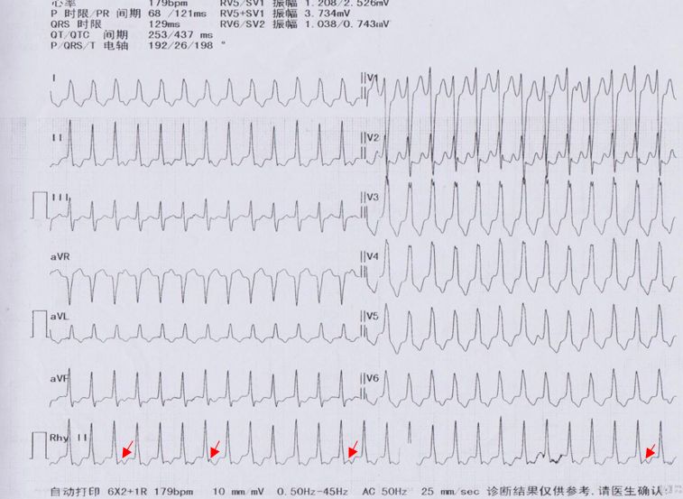病人突发心悸心电图示心率180次,反复发作心悸动态心电图显示什么