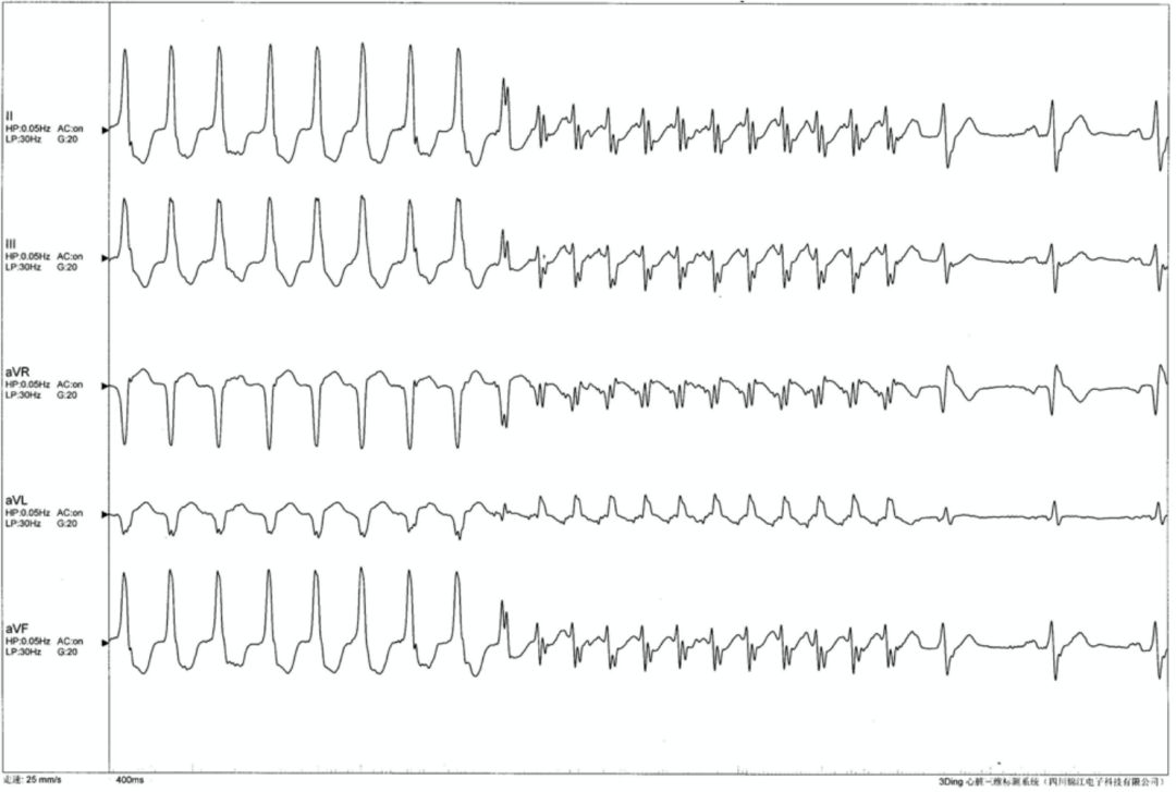 病人突发心悸心电图示心率180次,反复发作心悸动态心电图显示什么