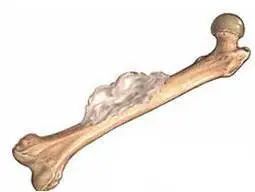 男孩得了恶性骨肿瘤,80多岁老人得了骨肿瘤怎么治疗