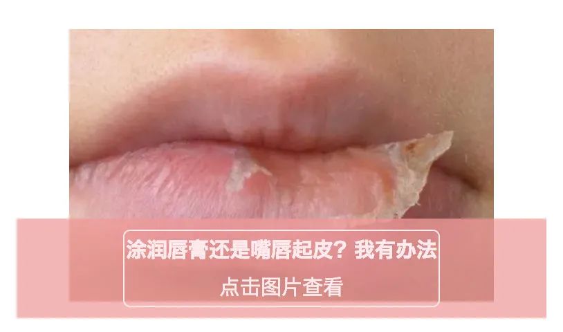 甲硝唑壬二酸去黑头的步骤,甲硝唑治黑头吗