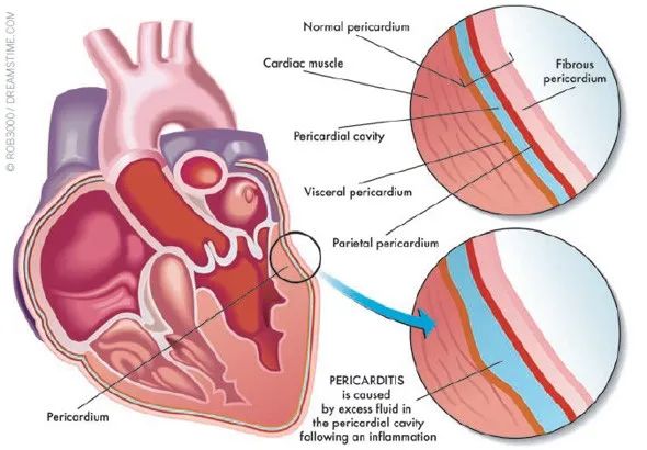 干货丨特发性心包炎如何管理,这篇讲清楚啦