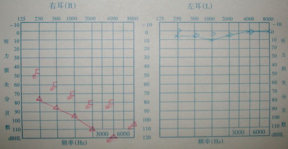 爱耳日听力突然下降了怎么办,爱耳日耳聋