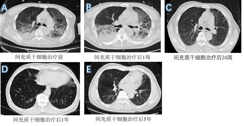 干细胞治疗前沿,造血干细胞前沿研究