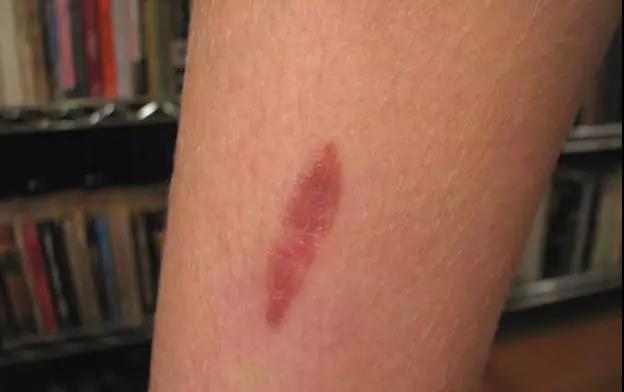 穿着衣服被开水烫伤急救,开水烫伤的急救措施