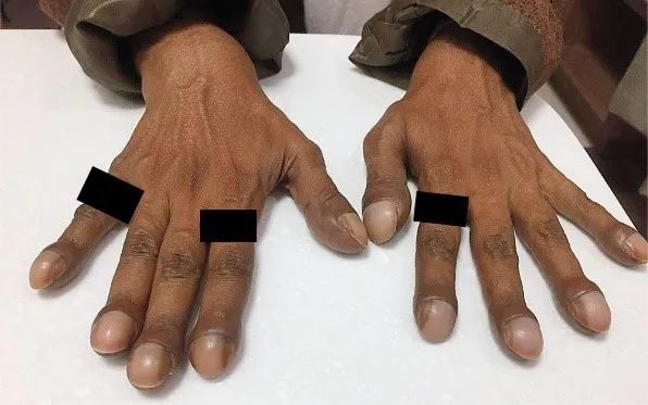 NEJM病例：肝肺综合征一例