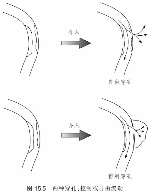 介入引起的血管并发症,介入栓塞治疗的并发症
