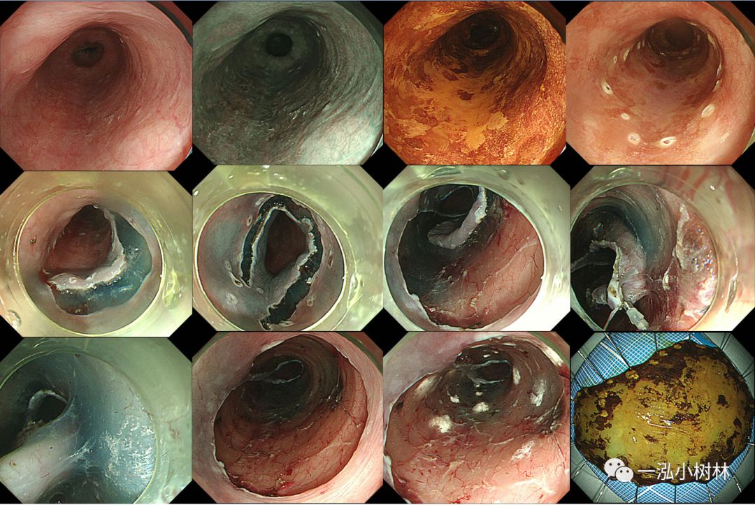食管癌早期内镜esd治疗能活多久,食管癌内镜esd手术后几天出院