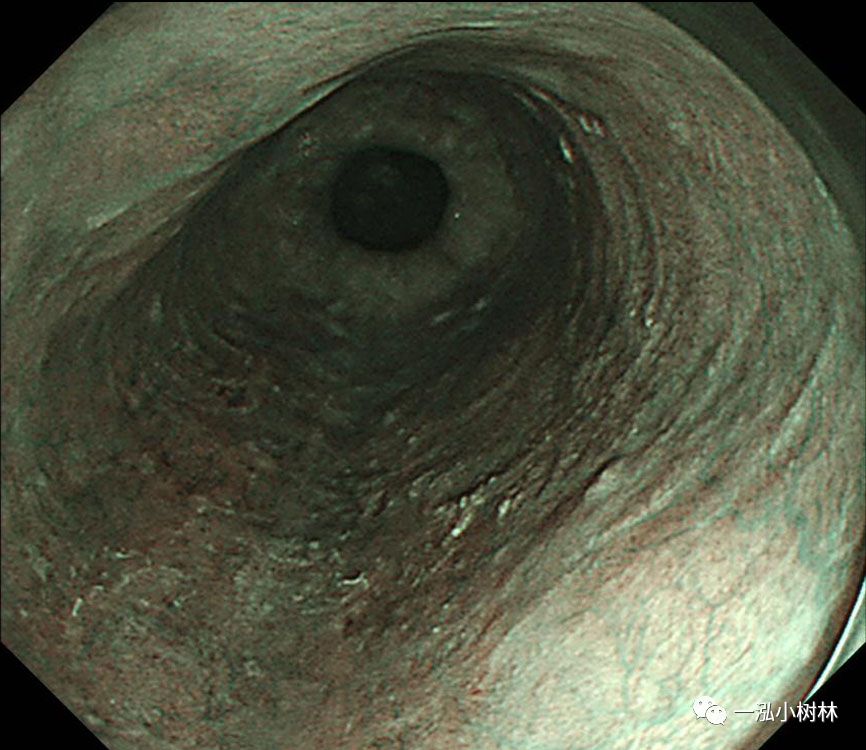 食管癌早期内镜esd治疗能活多久,食管癌内镜esd手术后几天出院