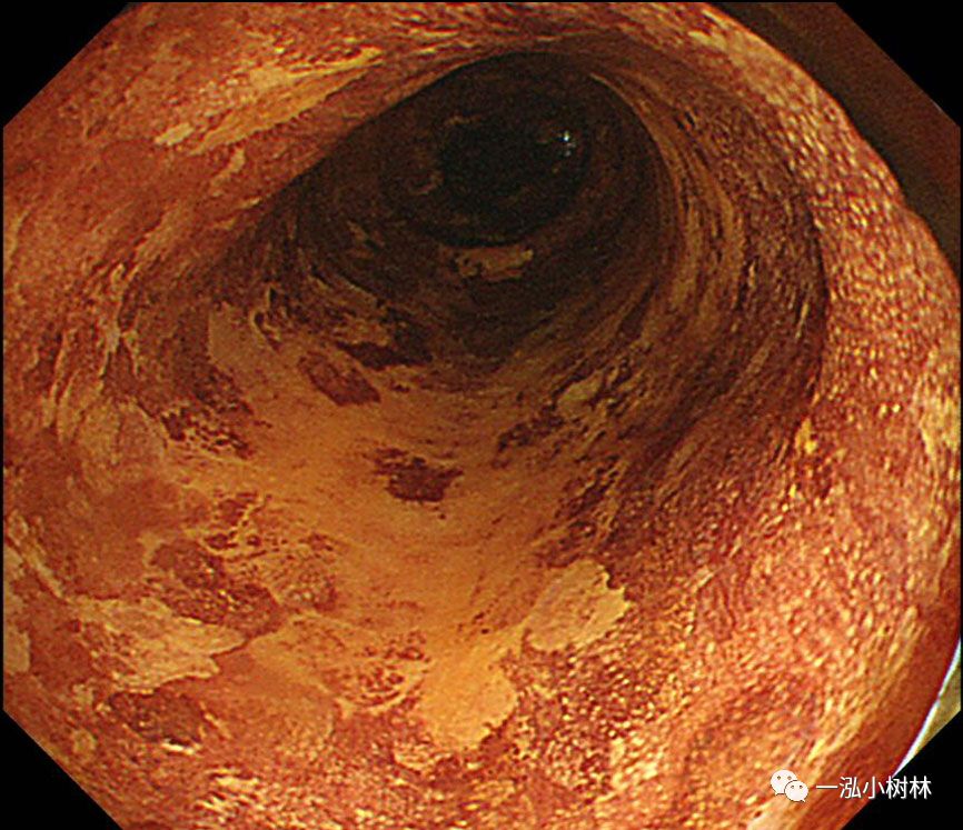 食管癌早期内镜esd治疗能活多久,食管癌内镜esd手术后几天出院