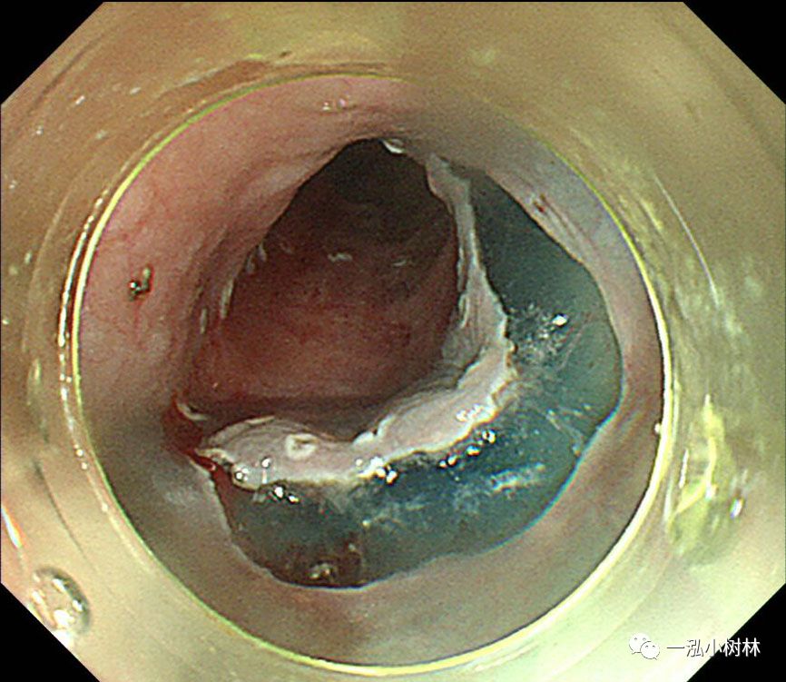 食管癌早期内镜esd治疗能活多久,食管癌内镜esd手术后几天出院
