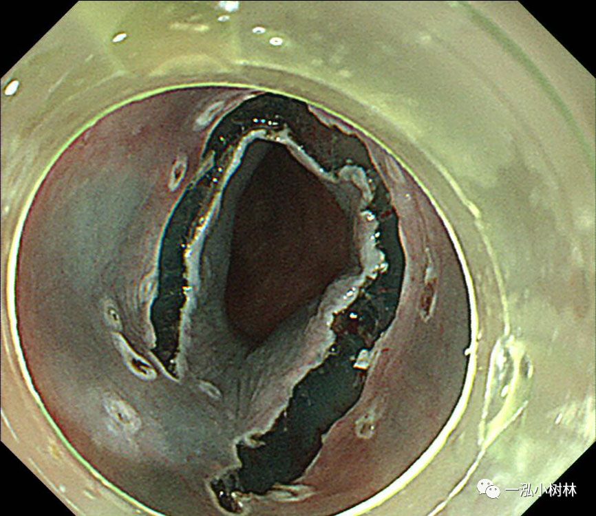 食管癌早期内镜esd治疗能活多久,食管癌内镜esd手术后几天出院