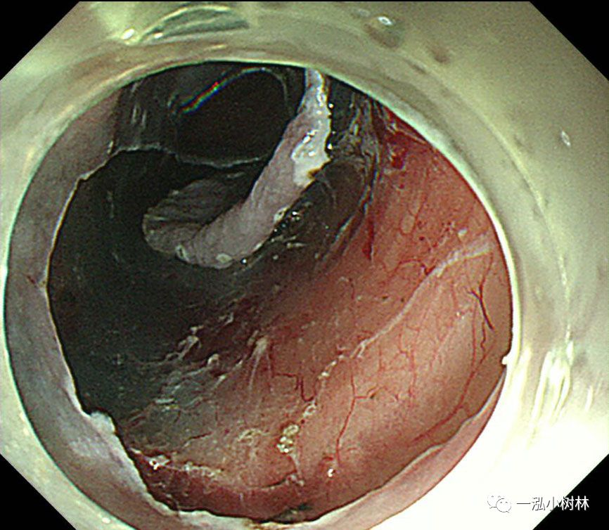 食管癌早期内镜esd治疗能活多久,食管癌内镜esd手术后几天出院