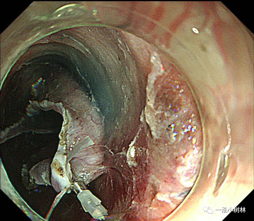 食管癌早期内镜esd治疗能活多久,食管癌内镜esd手术后几天出院
