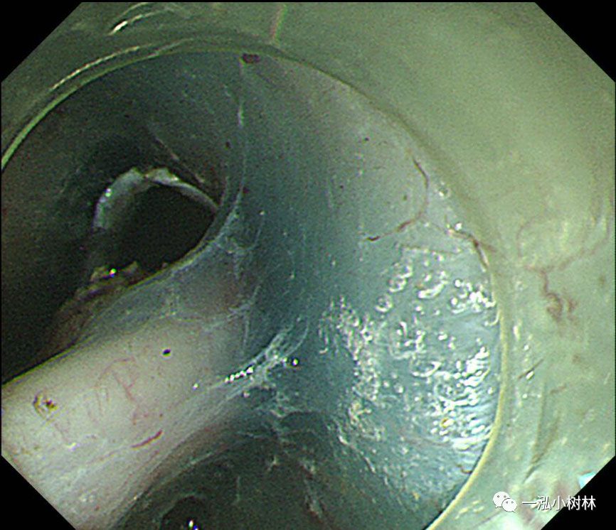 食管癌早期内镜esd治疗能活多久,食管癌内镜esd手术后几天出院