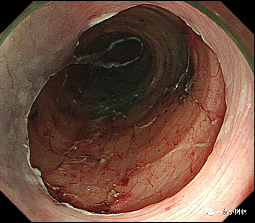 食管癌早期内镜esd治疗能活多久,食管癌内镜esd手术后几天出院