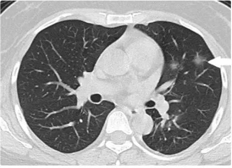新型冠状病毒肺炎早期ct影像,新型冠状病毒肺炎的ct影像学特征