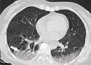 新型冠状病毒肺炎早期ct影像,新型冠状病毒肺炎的ct影像学特征