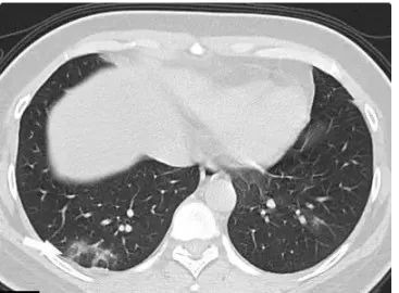 新型冠状病毒肺炎早期ct影像,新型冠状病毒肺炎的ct影像学特征