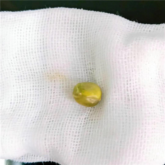 惊险！唐山妇幼耳鼻喉科一天收治7例异物患者