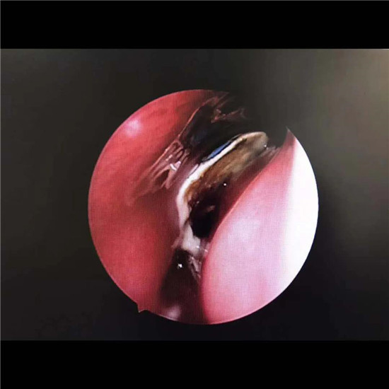 惊险！唐山妇幼耳鼻喉科一天收治7例异物患者