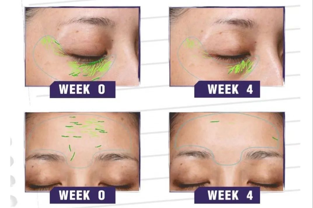 欧莱雅眼霜紫熨斗去眼纹,欧莱雅紫熨斗眼霜能祛干纹么