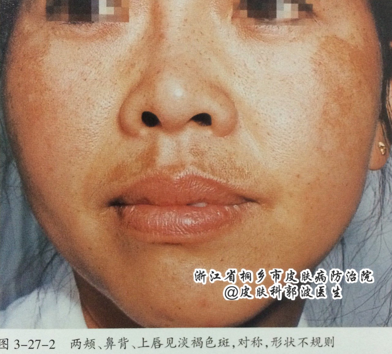 褐斑病是什么原因造成的,褐斑的原因和治疗方法