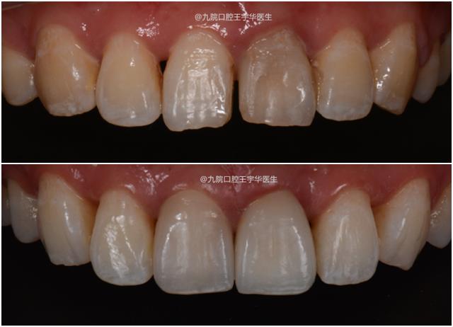 门牙中间有缝是否影响运势,门牙开缝是不是很丑