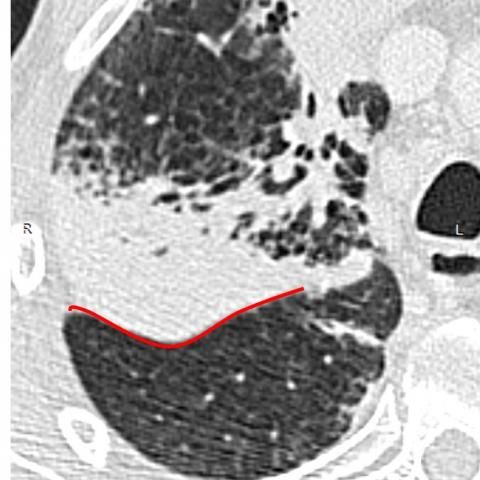 肺炎克雷伯菌败血症能治吗,肺炎克雷伯菌导致感染性休克