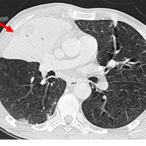 肺炎克雷伯菌败血症能治吗,肺炎克雷伯菌导致感染性休克