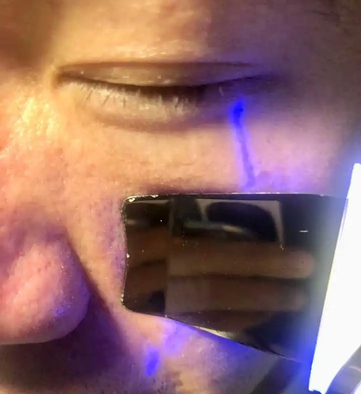 去除鼻子黑头视频大全,如何去除鼻子上的黑头12岁孩子