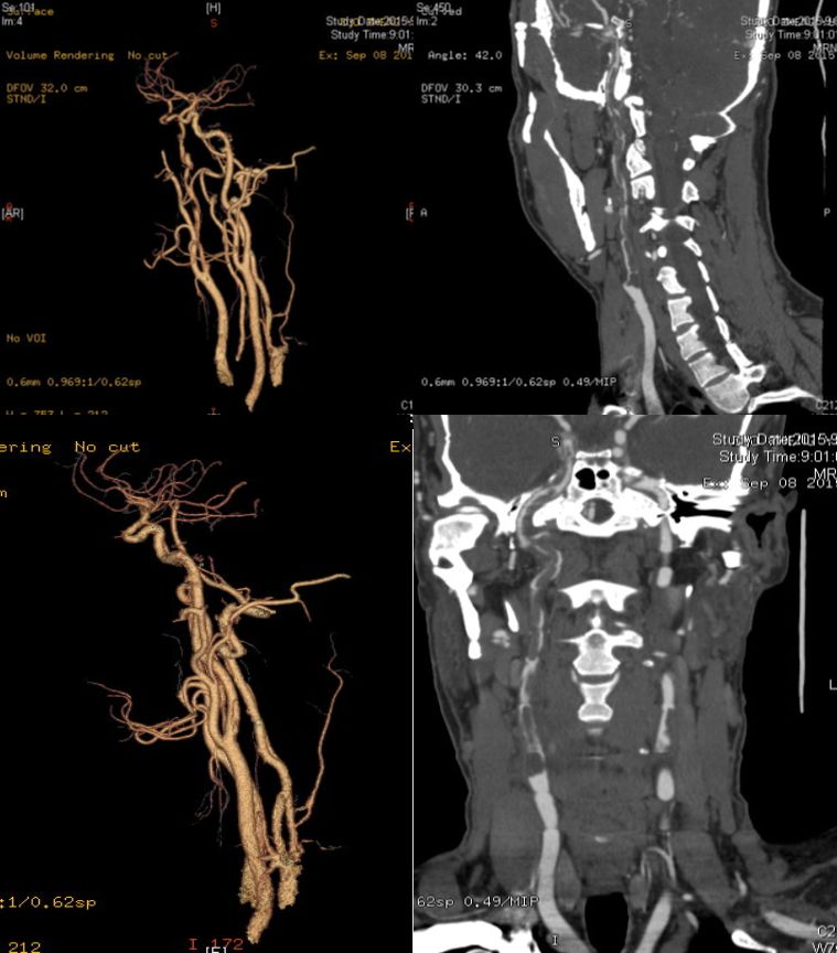 颈内动脉血栓和闭塞,颈内动脉漂浮血栓