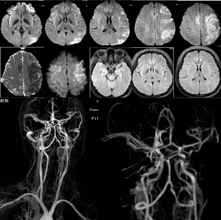 颈内动脉血栓和闭塞,颈内动脉漂浮血栓