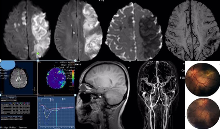 颈内动脉血栓和闭塞,颈内动脉漂浮血栓