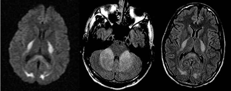 颈内动脉血栓和闭塞,颈内动脉漂浮血栓