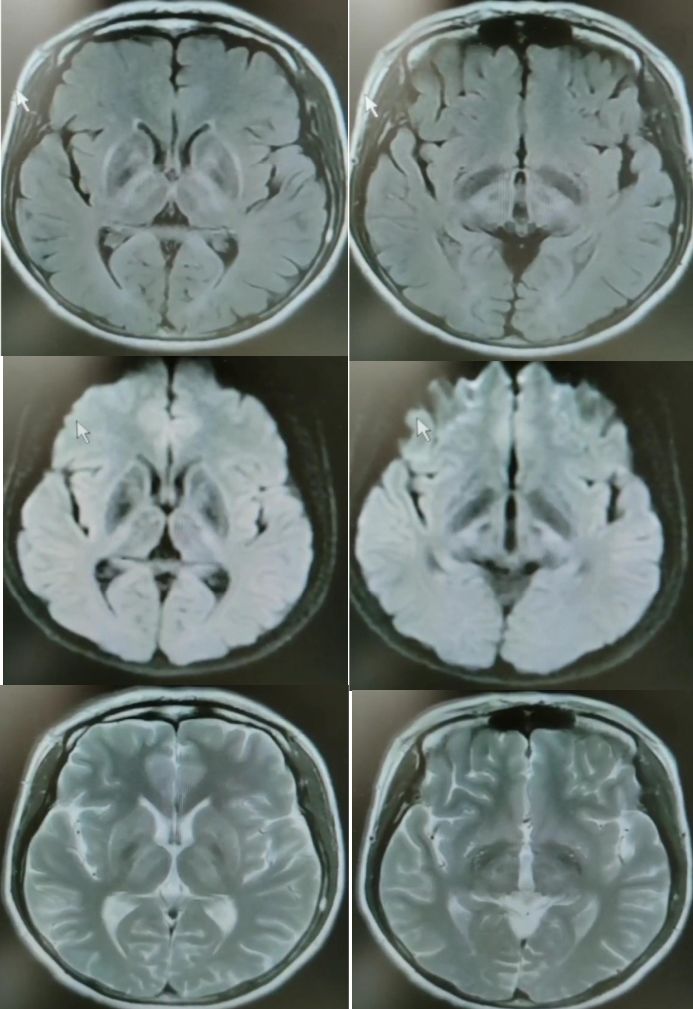 颈内动脉血栓和闭塞,颈内动脉漂浮血栓