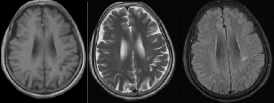 颈内动脉血栓和闭塞,颈内动脉漂浮血栓