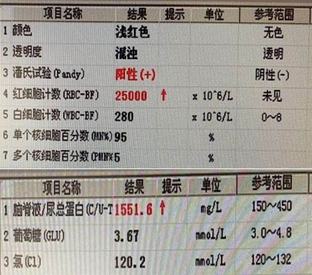 颈内动脉血栓和闭塞,颈内动脉漂浮血栓