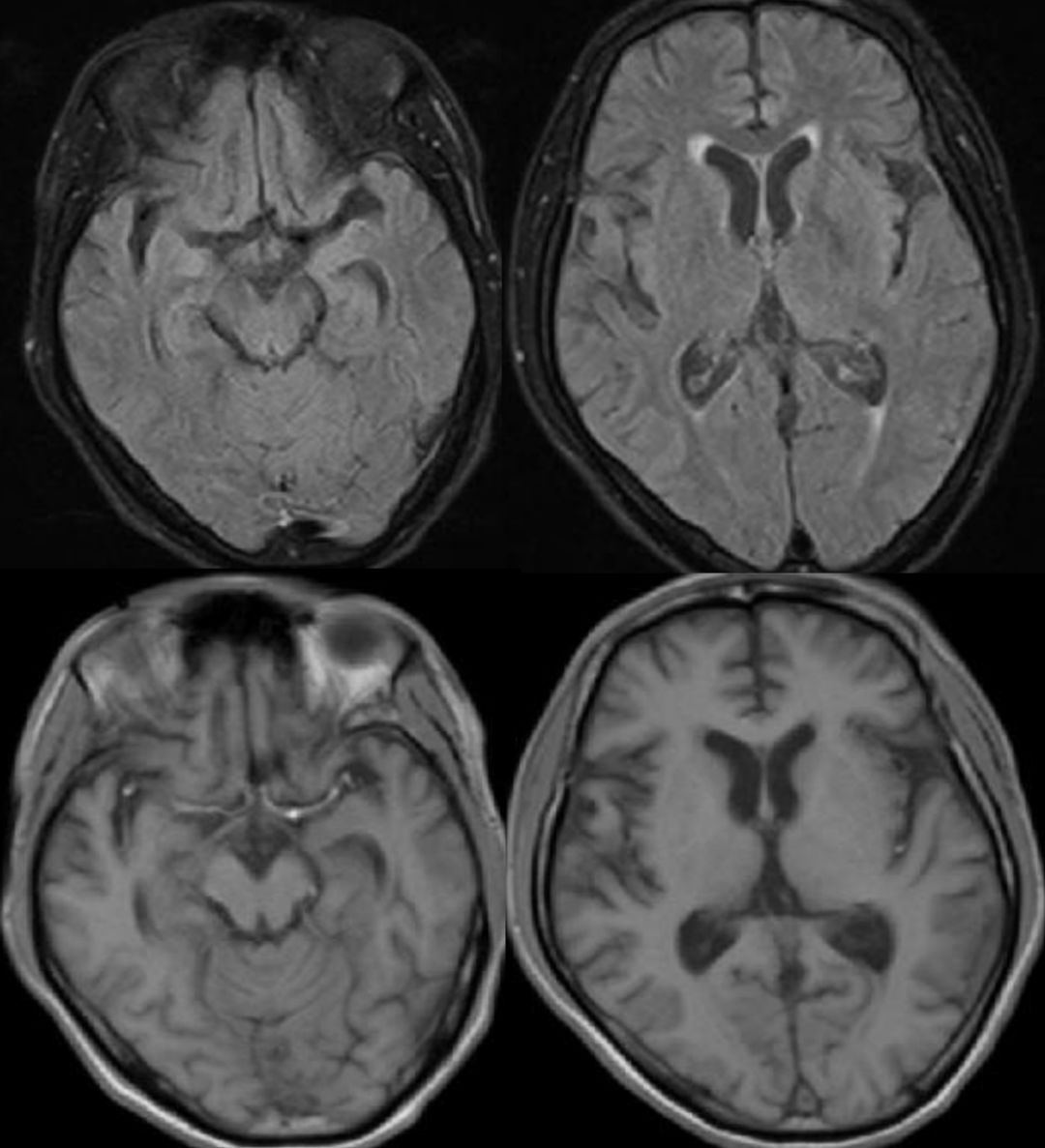 颈内动脉血栓和闭塞,颈内动脉漂浮血栓