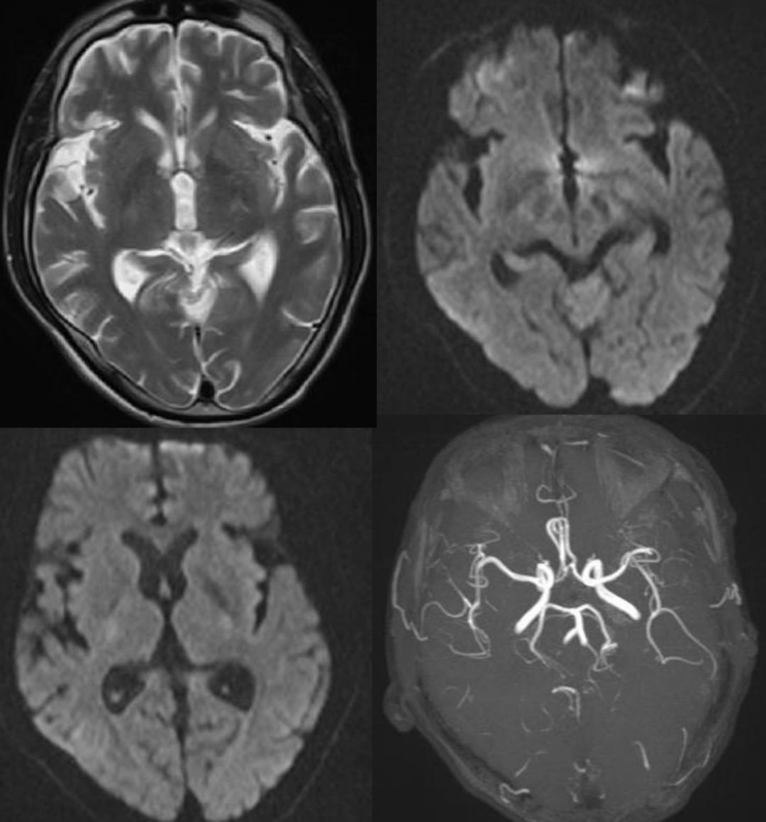颈内动脉血栓和闭塞,颈内动脉漂浮血栓