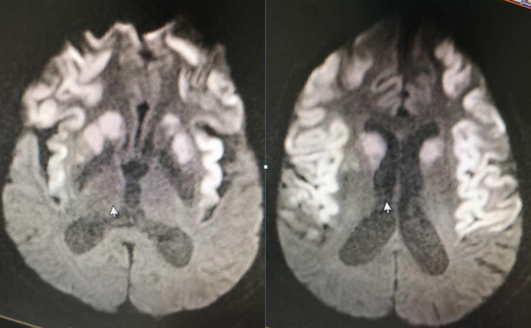 颈内动脉血栓和闭塞,颈内动脉漂浮血栓