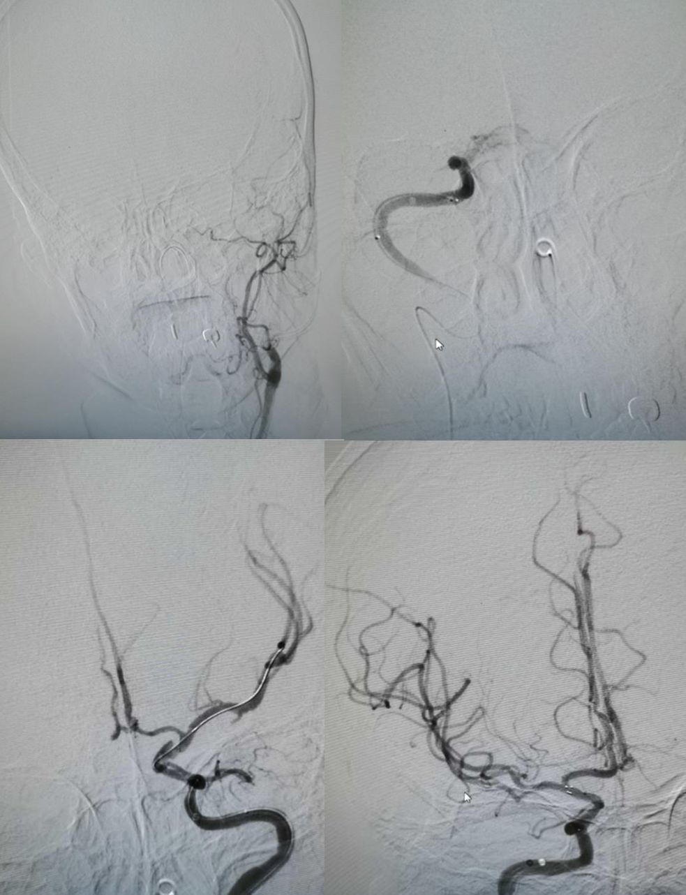 颈内动脉血栓和闭塞,颈内动脉漂浮血栓