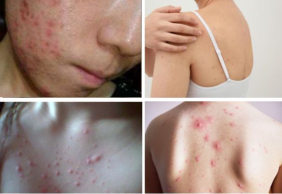 脸上痘痘反反复复毛孔大,痘痘黑头粉刺出油